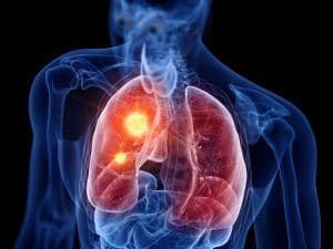 Filing for Workers’ Compensation If You Have Lung Disease